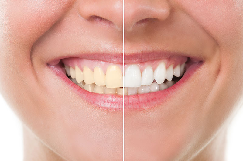 Teeth Whitening in Mamaroneck